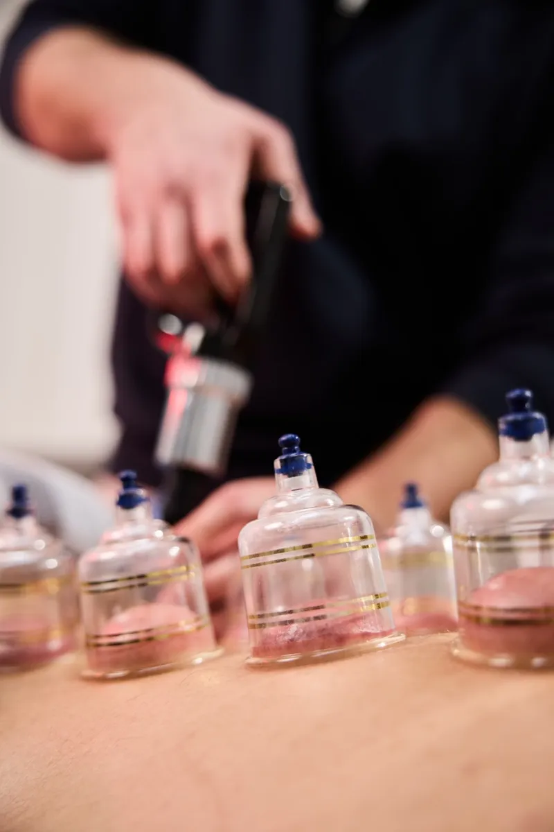 Cupping therapy session at Synergy Clinic